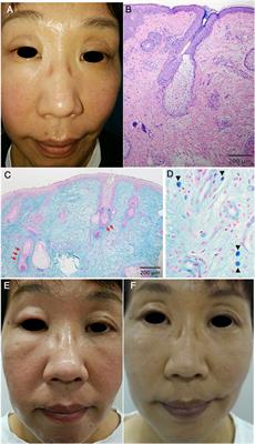 Successful control of Morbihan disease with dapsone: a case report and literature review